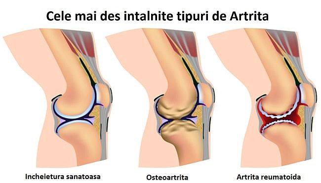 cum să bată artrita la genunchi)